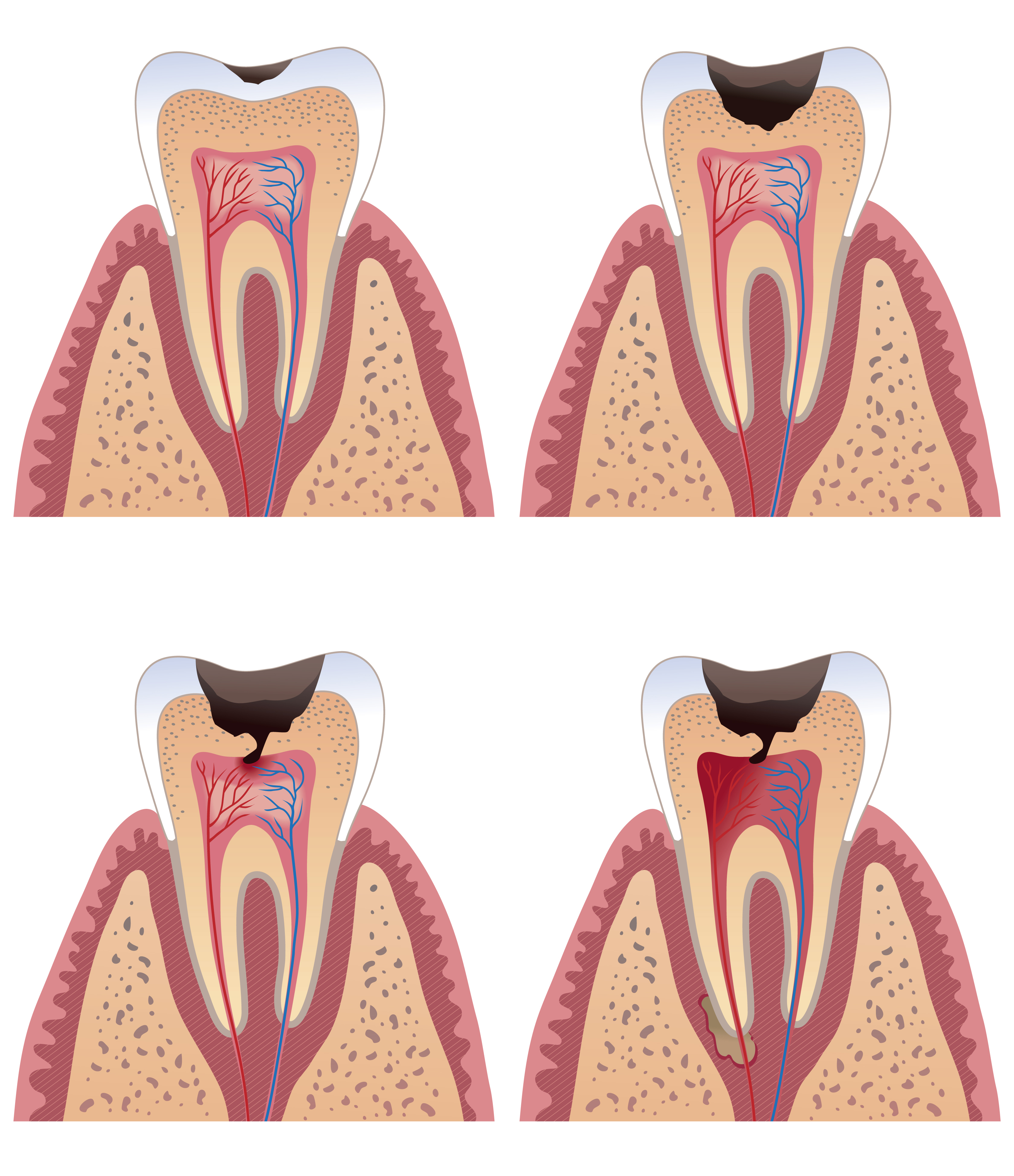 Caries stages