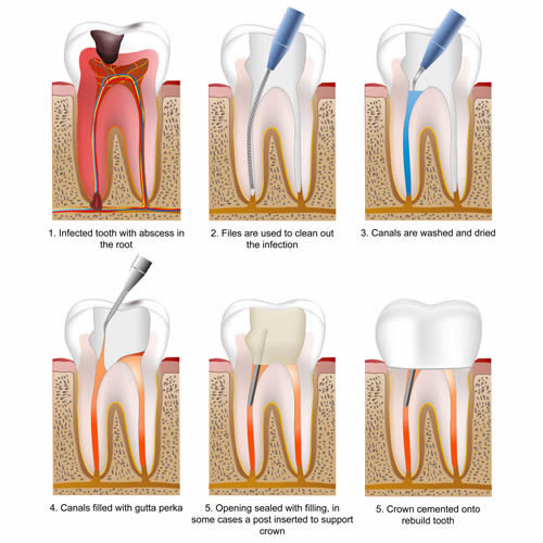 รักษารากฟัน โดย dental chiangmai clinic