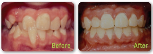 จัดฟันแบบใส เชียงใหม่ โดย cm dental clinic, Chiang mai
